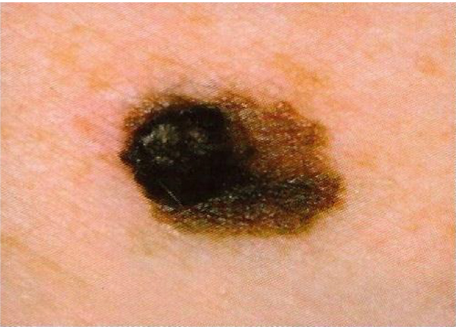Melanoma checker - skin picture