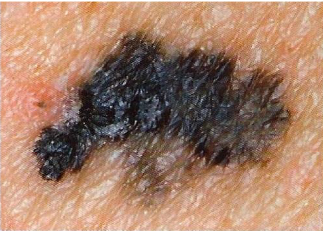 Melanoma checker - skin picture